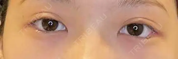 二重埋没 / 目尻切開 / タレ目形成・グラマラスライン（埋没） LOUIS CLINIC 二子玉川院【ルイクリニック】 AFTER メイン用