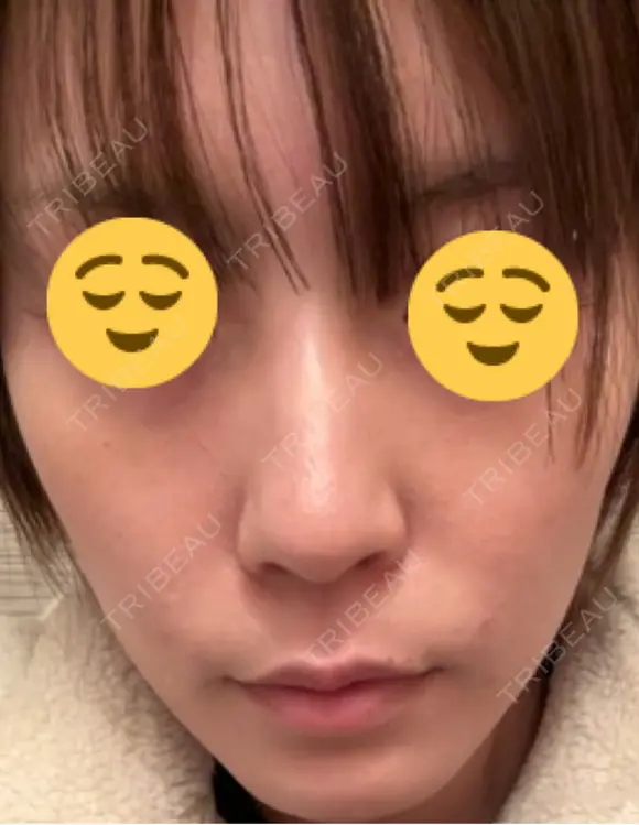 医療脱毛（顔） ZX-CLINIC 梅田院 AFTER メイン用