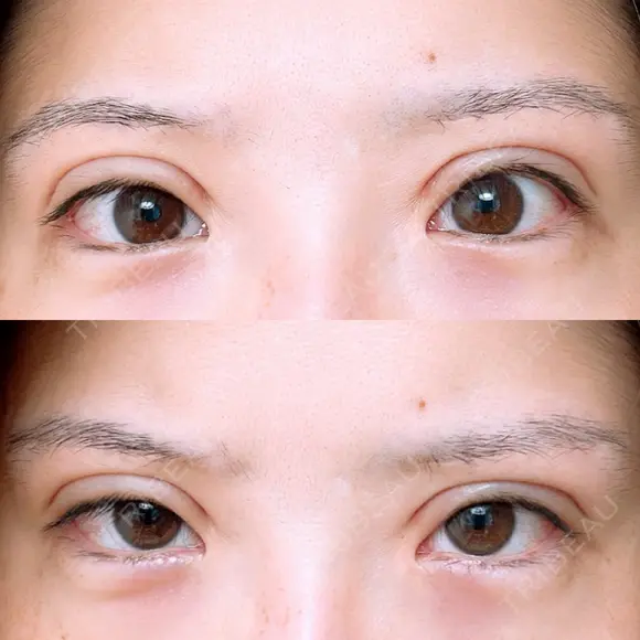 二重切開 アネシス美容クリニック AFTER メイン用