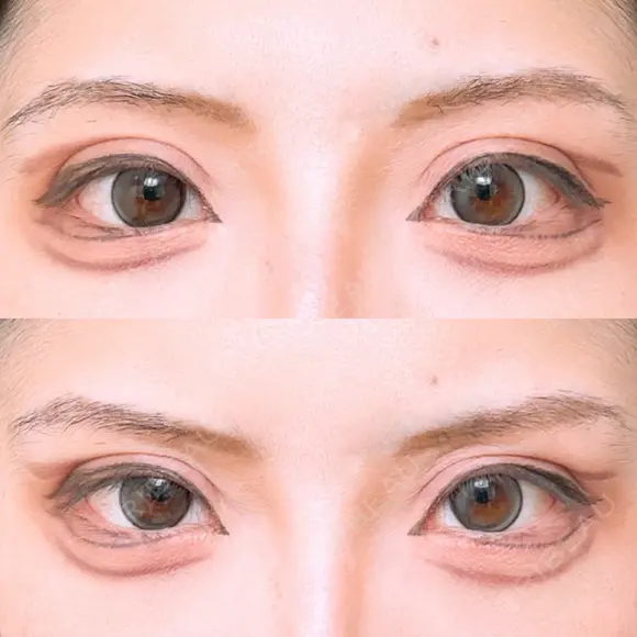 二重切開 アネシス美容クリニック DAY 31 メイン用