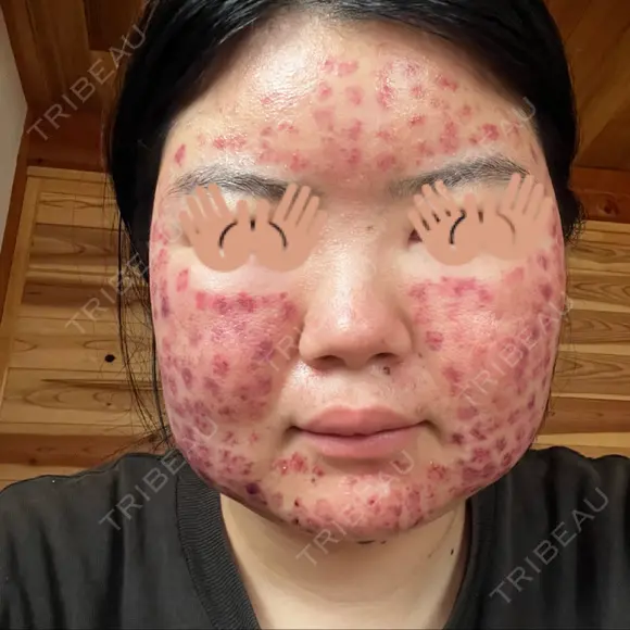 美肌レーザー / 赤み除去レーザー / ニキビ治療 医療法人河田外科形成外科 DAY 1 メイン用