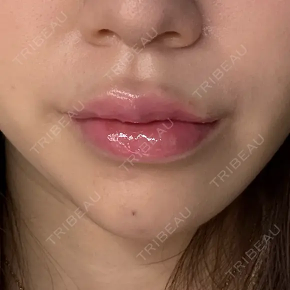 ヒアルロン酸注入（あご） / ヒアルロン酸注入（唇） / ボトックス（口角） ルラ美容クリニック 大阪本院 AFTER メイン用