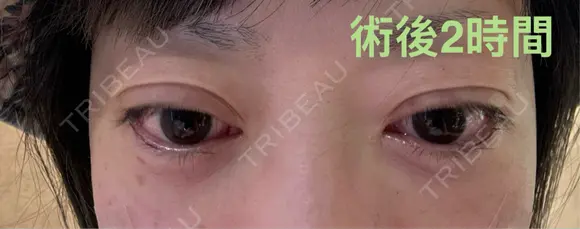 クマ治療 お茶の水美容形成クリニック DAY 10 メイン用