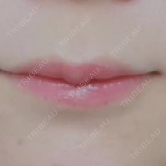 ヒアルロン酸注入（唇） フィラークリニック 大阪梅田院 DAY 3 メイン用