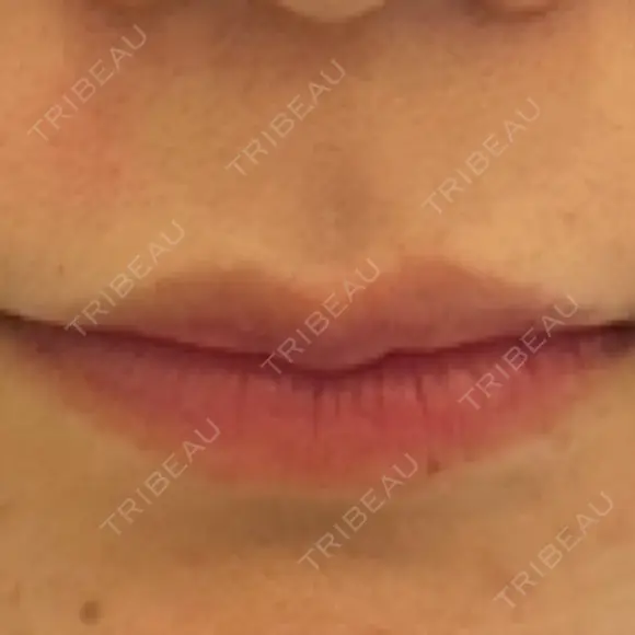 ヒアルロン酸注入（唇） フィラークリニック 大阪梅田院 DAY 4 メイン用
