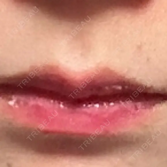 ヒアルロン酸注入（唇） フィラークリニック 大阪梅田院 DAY 6 メイン用