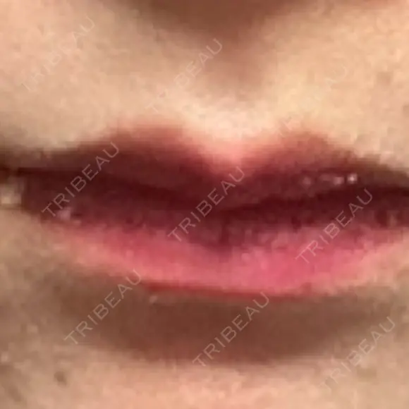 ヒアルロン酸注入（唇） フィラークリニック 大阪梅田院 DAY 8 メイン用