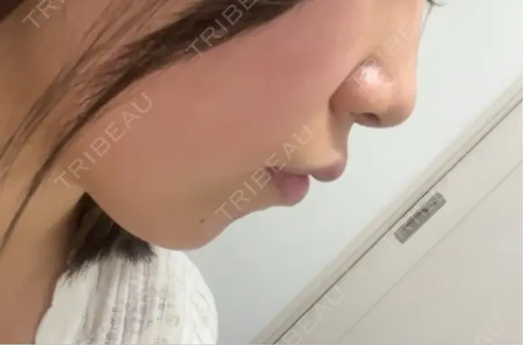 ヒアルロン酸注入（あご） / ヒアルロン酸注入（鼻翼基部） / RF（高周波）たるみ治療 gift clinic DAY 0 メイン用