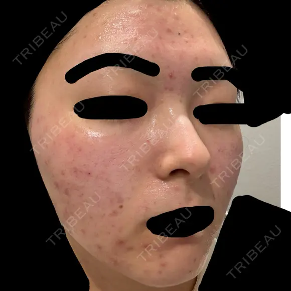 ニードルRF（ポテンツァなど） GRACY TOKYO CLINIC【グレイシートウキョウクリニック】 DAY 0 メイン用
