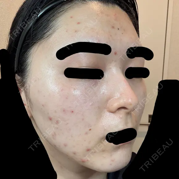 ニードルRF（ポテンツァなど） GRACY TOKYO CLINIC【グレイシートウキョウクリニック】 DAY 0 メイン用