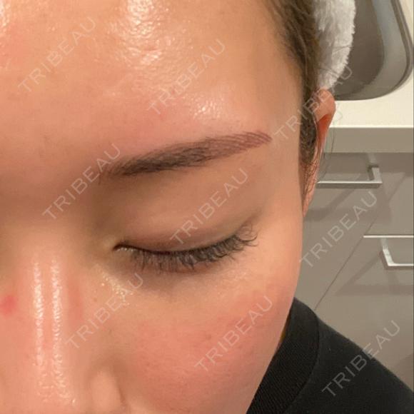 ダーマペン LIFIX BEAUTY CLINIC DAY 3 メイン用