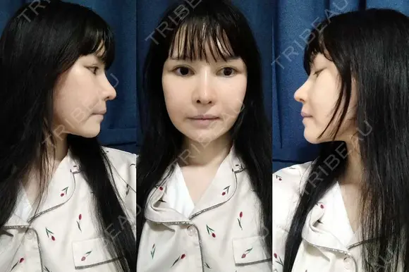 鼻修正 / 切開リフト / 鼻翼基部形成（貴族手術） リッツ美容外科 東京院 DAY 50 メイン用