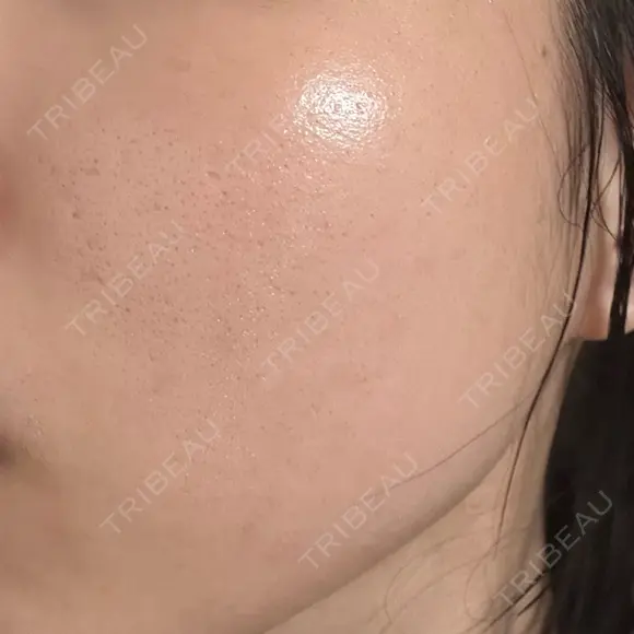 エレクトロポレーション / ルメッカ ON-CLINIC Beauty DAY 0 メイン用