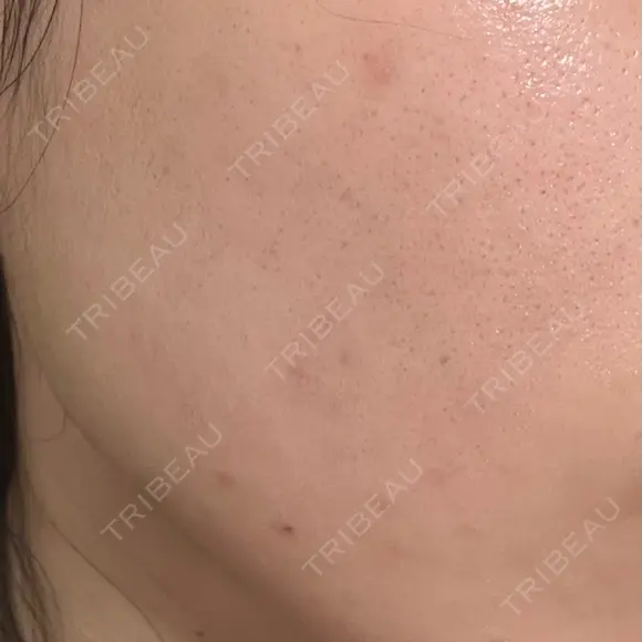 エレクトロポレーション / ルメッカ ON-CLINIC Beauty DAY 10 メイン用