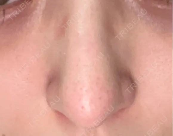 鼻尖形成（切開） / 小鼻縮小（切開） / 軟骨移植 / 鼻尖縮小 東京シンデレラ美容外科 新宿院 DAY 121 メイン用