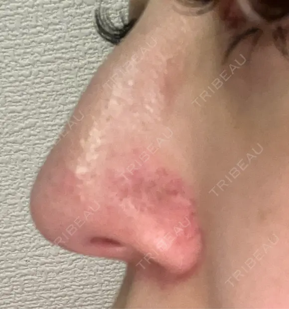 鼻尖形成（切開） / 小鼻縮小（切開） / 軟骨移植 / 鼻尖縮小 東京シンデレラ美容外科 新宿院 DAY 121 メイン用