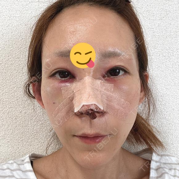 鼻尖形成（切開） / 鼻中隔延長（切開） / 糸リフト / 軟骨移植 / 骨切幅寄せ / 鼻孔縁挙上 / 鼻柱下降・鼻唇角形成（猫手術） / 肌ヒアルロン酸注入（たるみ・シワ改善） / ヒアルロン酸注入（あご） / ボトックス（額） / ヒアルロン酸注入（鼻翼基部） 大阪TAクリニック DAY 0 メイン用