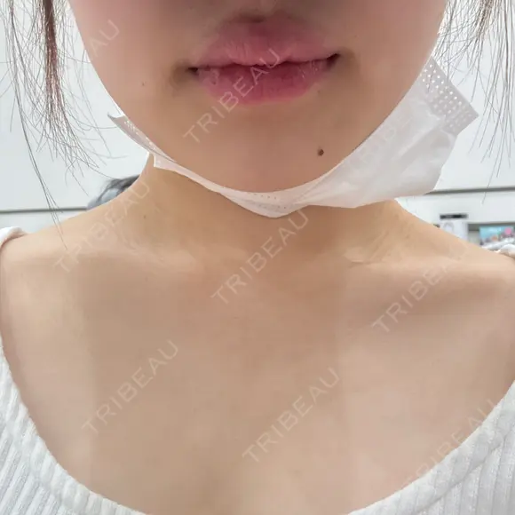 ハイフ（顔） 表参道メディカルクリニック 名古屋院 DAY 1 メイン用