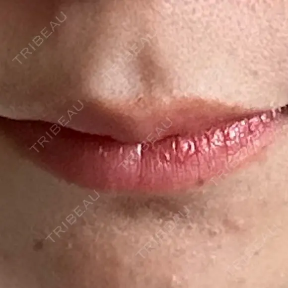 ヒアルロン酸注入（唇） フィラークリニック 大阪梅田院 DAY 7 メイン用