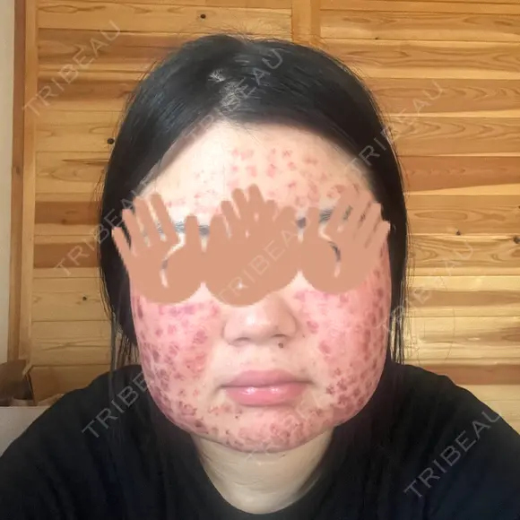 美肌レーザー / 赤み除去レーザー / ニキビ治療 医療法人河田外科形成外科 DAY 3 メイン用