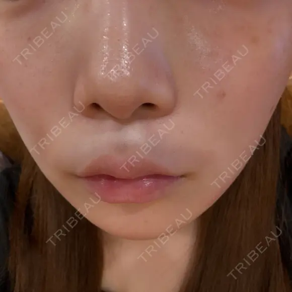 ルメッカ 大美会クリニック 梅田院 AFTER メイン用