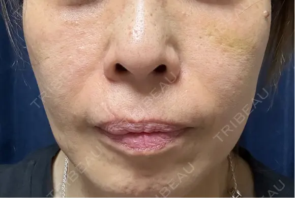 ショッピングリフト Natural Skin Clinic 笹塚院 DAY 7 メイン用
