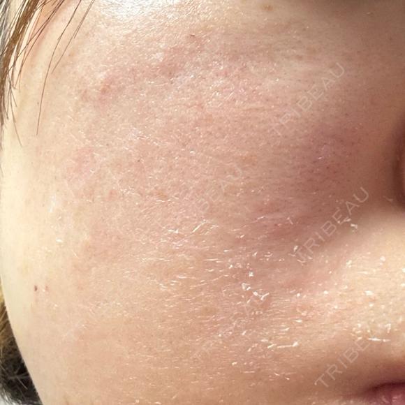 ピーリング（ハリ・ツヤ） / ルメッカ PureMe Skin Clinic（ピュアミースキンクリニック麻布） DAY 4 メイン用
