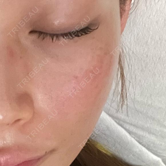 ダーマペン LIFIX BEAUTY CLINIC AFTER メイン用