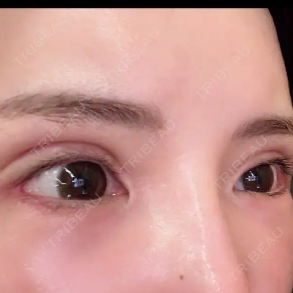 二重切開 / 眼瞼下垂（切開） / その他（目元） / 目尻切開 / タレ目形成・グラマラスライン（切開） オーキッド美容クリニック東京御徒町 DAY 20 メイン用