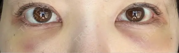 クマ治療 / 下まぶたたるみ取り / 下まぶたの脂肪取り / 脂肪注入（目の下） / ボトックス（あご） / ボトックス（眉間） お茶の水美容形成クリニック DAY 2 メイン用