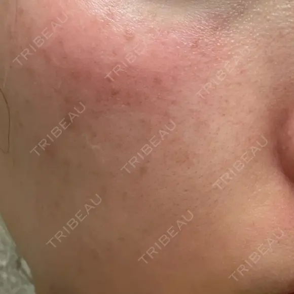 フォトRF 共立美容外科 仙台院 DAY 0 メイン用