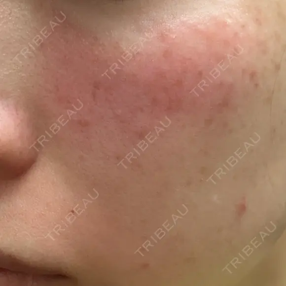 フォトRF 共立美容外科 仙台院 DAY 0 メイン用