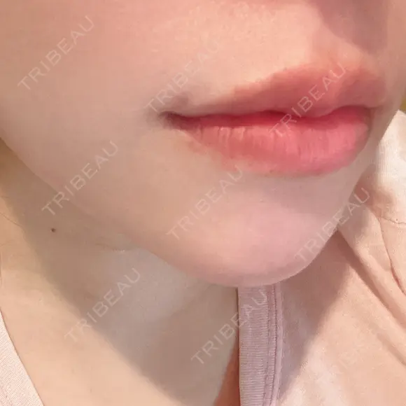 ヒアルロン酸注入（唇） AZ BEAUTY CLINIC DAY 2 メイン用