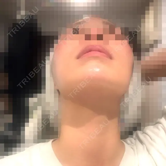 糸リフト / 脂肪吸引（顔） / ジョールファット除去 A CLINIC（エークリニック） 新宿院 DAY 1 メイン用