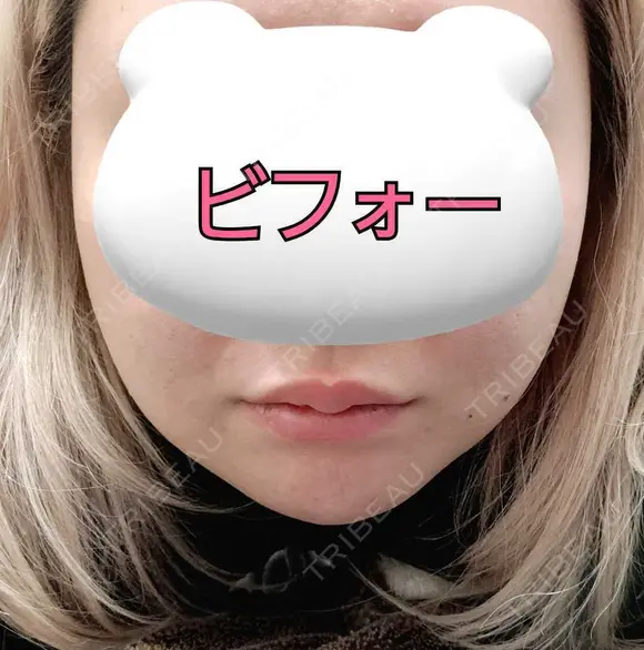 ボトックス（エラ・小顔） / ヒアルロン酸注入（唇） / ボトックス（首） ROHE CLINIC GINZA AFTER メイン用