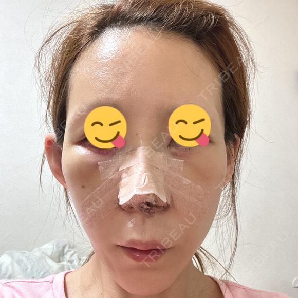 鼻尖形成（切開） / 鼻中隔延長（切開） / 糸リフト / 軟骨移植 / 骨切幅寄せ / 鼻孔縁挙上 / 鼻柱下降・鼻唇角形成（猫手術） / 肌ヒアルロン酸注入（たるみ・シワ改善） / ヒアルロン酸注入（あご） / ボトックス（額） / ヒアルロン酸注入（鼻翼基部） 大阪TAクリニック DAY 1 メイン用