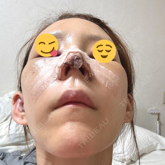 鼻尖形成（切開） / 鼻中隔延長（切開） / 糸リフト / 軟骨移植 / 骨切幅寄せ / 鼻孔縁挙上 / 鼻柱下降・鼻唇角形成（猫手術） / 肌ヒアルロン酸注入（たるみ・シワ改善） / ヒアルロン酸注入（あご） / ボトックス（額） / ヒアルロン酸注入（鼻翼基部） 大阪TAクリニック DAY 1 メイン用