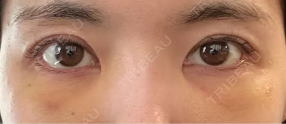 クマ治療 / 下まぶたたるみ取り / 下まぶたの脂肪取り / 脂肪注入（目の下） / ボトックス（あご） / ボトックス（眉間） お茶の水美容形成クリニック DAY 3 メイン用