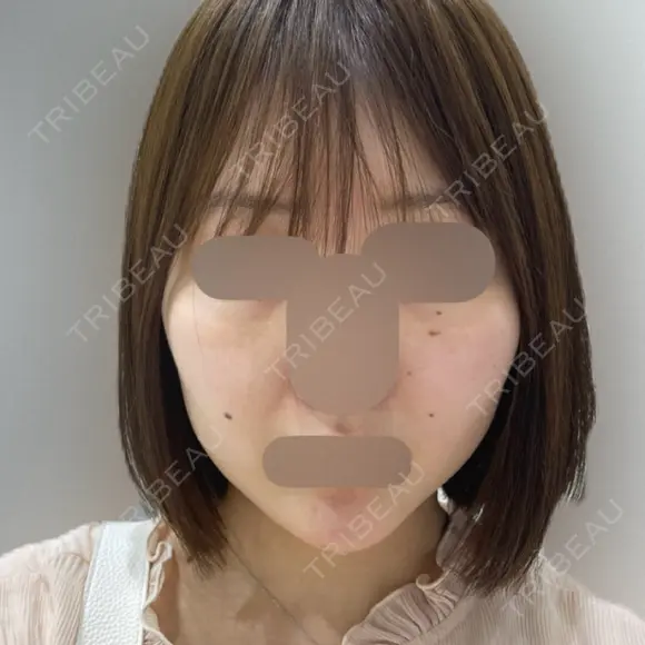RF（高周波）たるみ治療 ルラ美容クリニック 福岡本院 DAY 3 メイン用