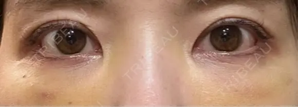 クマ治療 / 下まぶたたるみ取り / 下まぶたの脂肪取り / 脂肪注入（目の下） / ボトックス（あご） / ボトックス（眉間） お茶の水美容形成クリニック DAY 4 メイン用