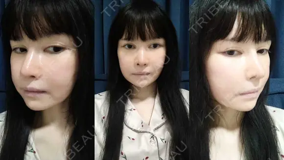 鼻修正 / 切開リフト / 鼻翼基部形成（貴族手術） リッツ美容外科 東京院 DAY 56 メイン用