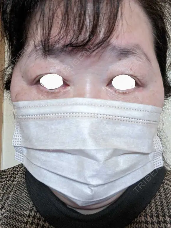 下まぶたたるみ取り / 下まぶたの脂肪取り / 脂肪注入（目の下） アリエル美容クリニック 郡山院 DAY 125 メイン用