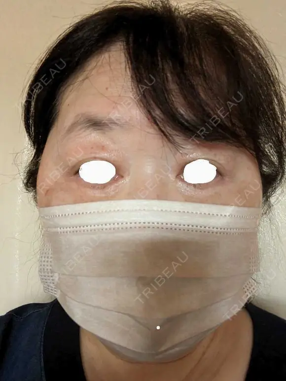 下まぶたたるみ取り / 下まぶたの脂肪取り / 脂肪注入（目の下） アリエル美容クリニック 郡山院 DAY 154 メイン用