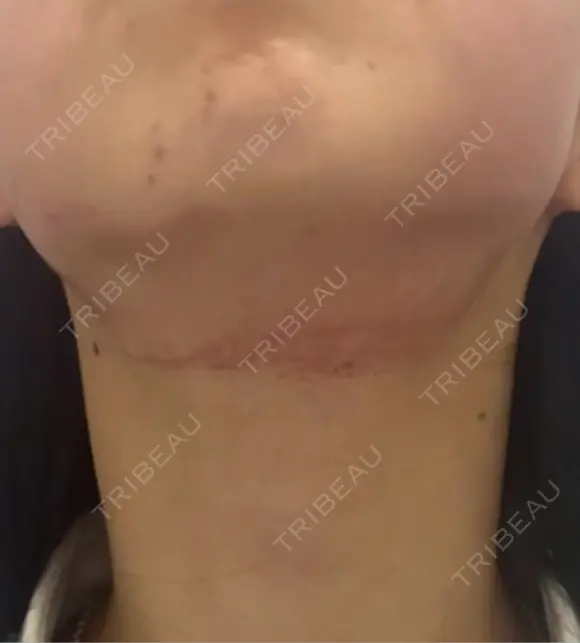 RF（高周波）たるみ治療 ルラ美容クリニック 札幌本院 DAY 0 メイン用