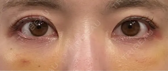 クマ治療 / 下まぶたたるみ取り / 下まぶたの脂肪取り / 脂肪注入（目の下） / ボトックス（あご） / ボトックス（眉間） お茶の水美容形成クリニック DAY 5 メイン用