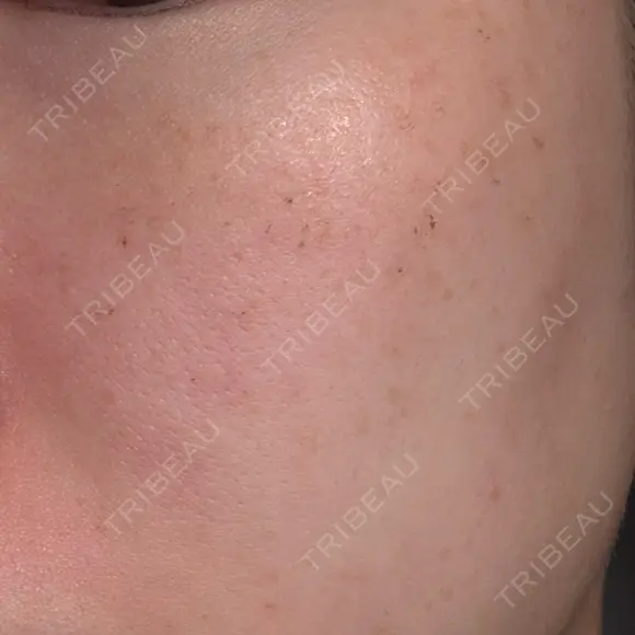 フォトRF 共立美容外科 仙台院 DAY 3 メイン用