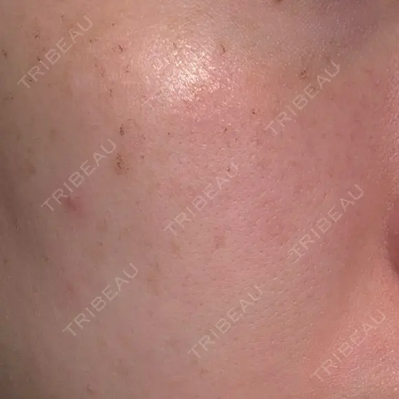 フォトRF 共立美容外科 仙台院 DAY 3 メイン用