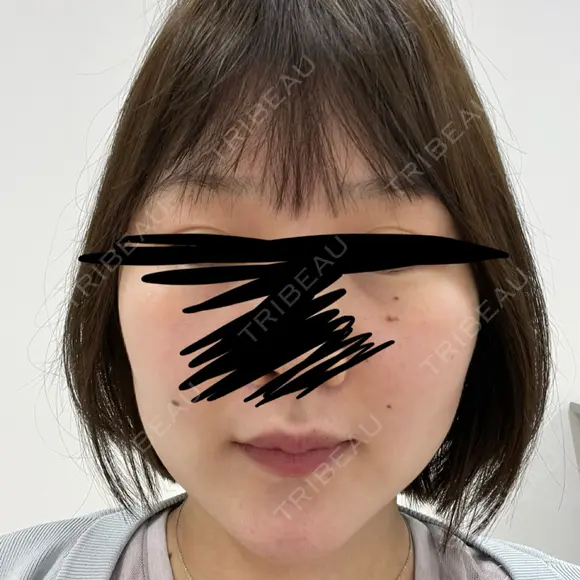 RF（高周波）たるみ治療 ルラ美容クリニック 福岡本院 DAY 5 メイン用