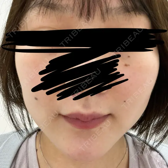 RF（高周波）たるみ治療 ルラ美容クリニック 福岡本院 DAY 6 メイン用