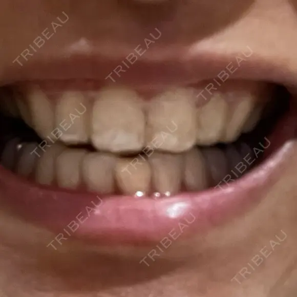 ホワイトニング 緑のテラス歯科クリニック AFTER メイン用